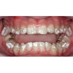 Universidade Positivo seleciona pacientes para tratamento gratuito com Invisalign